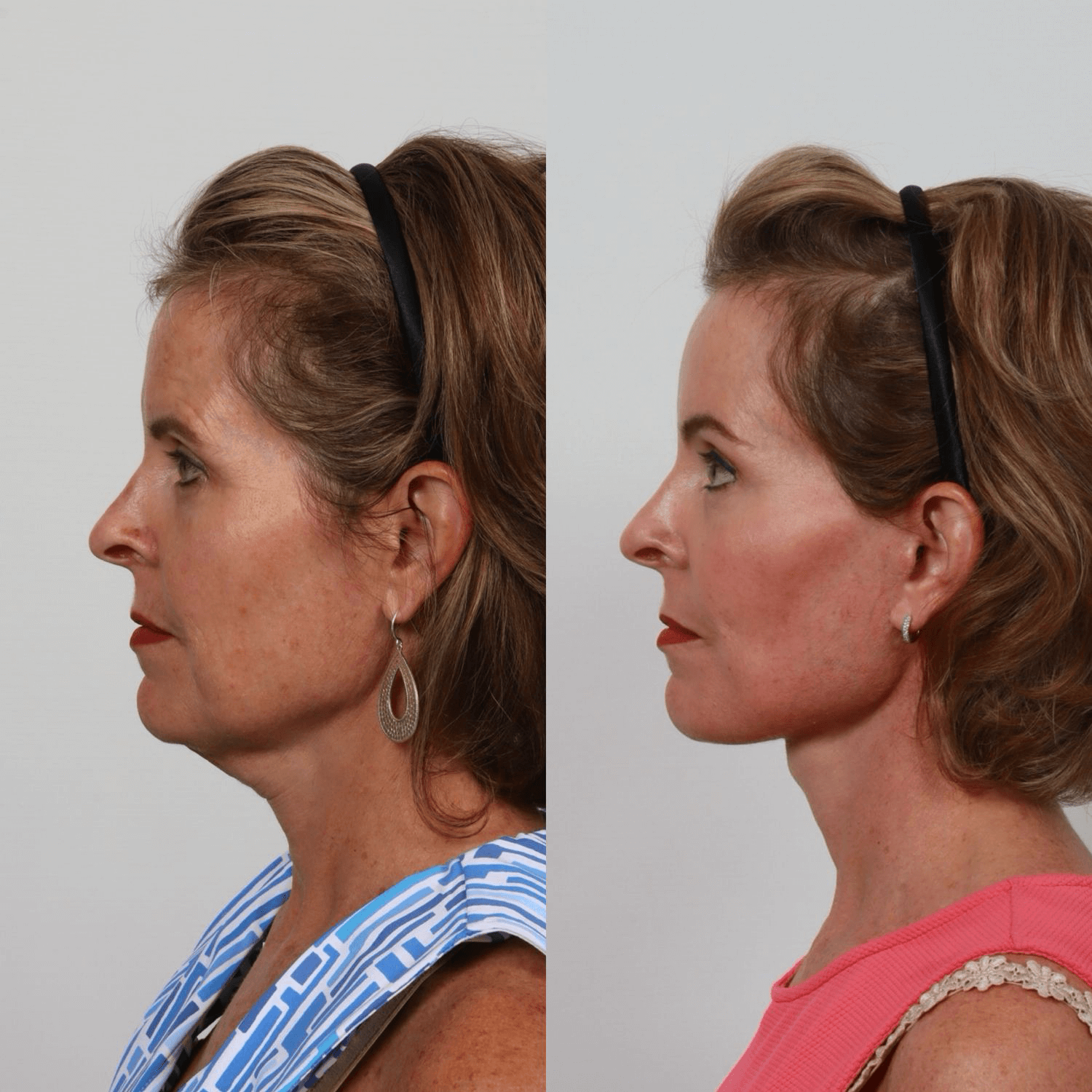 Before and after profile view of a woman.