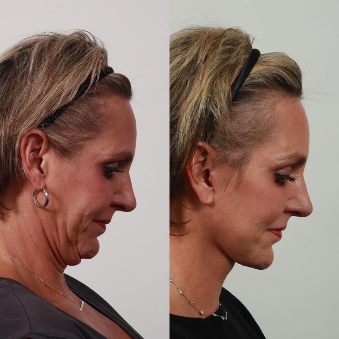 Before and after profile comparison of facelift.