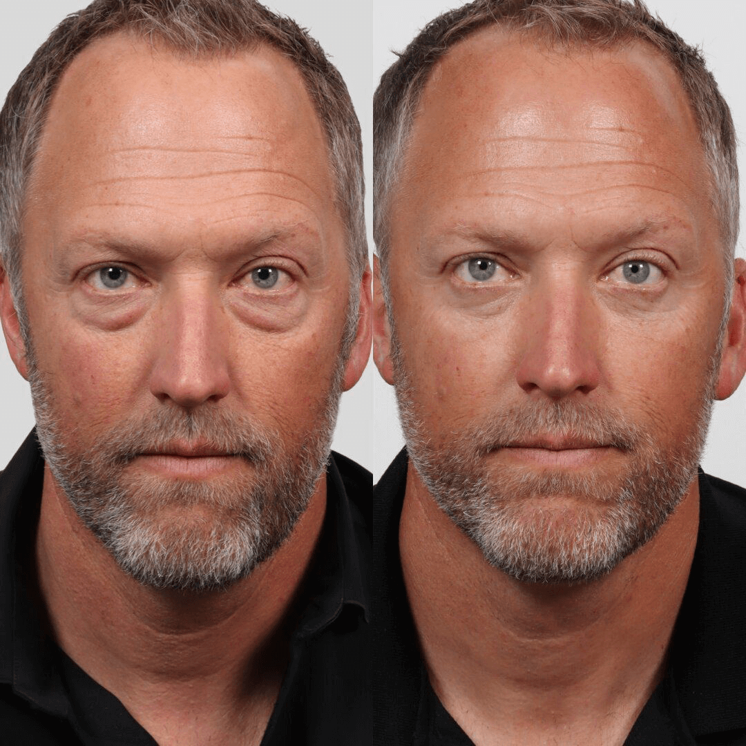 Before and after facial rejuvenation comparison.