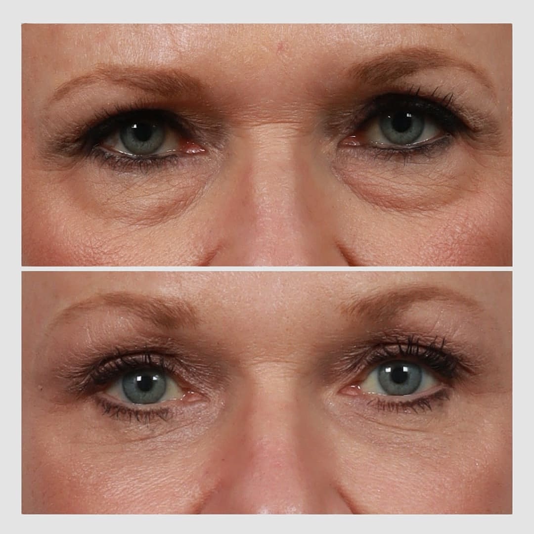 Brow Lift Before & After