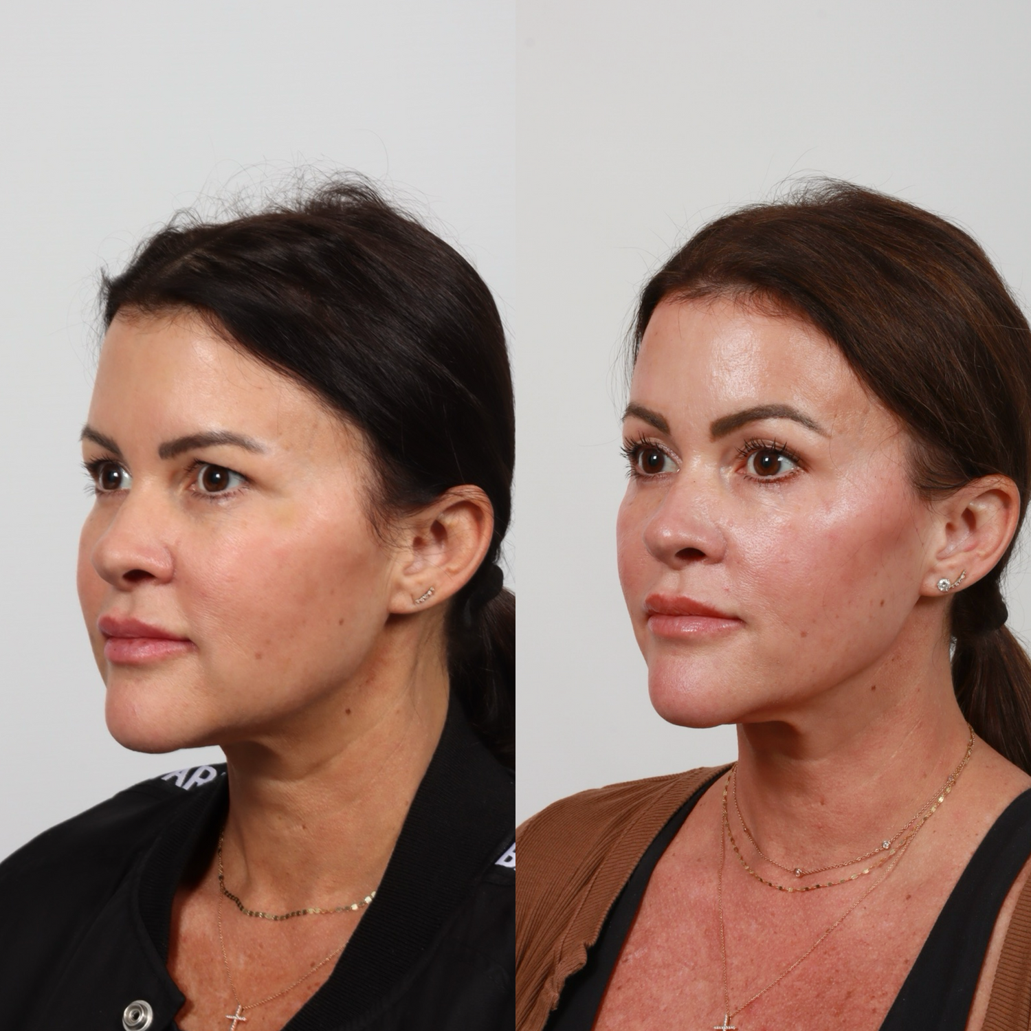 Brow Lift Before & After