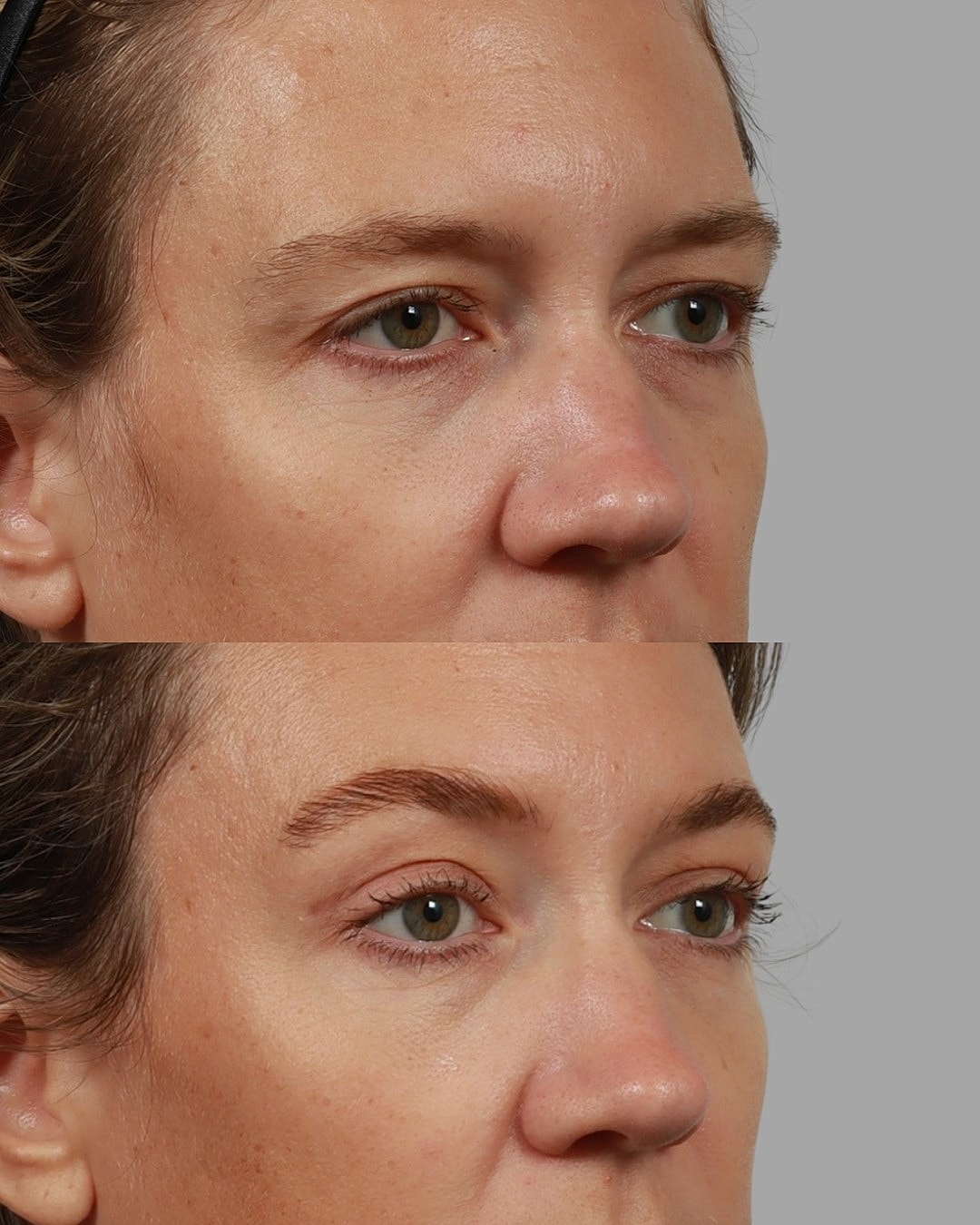Brow Lift Before & After