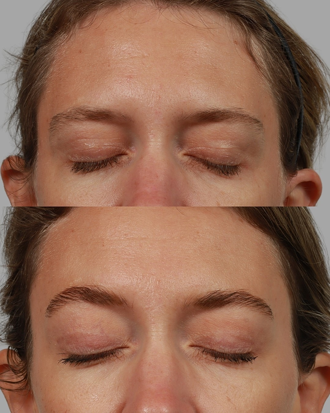 Brow Lift Before & After
