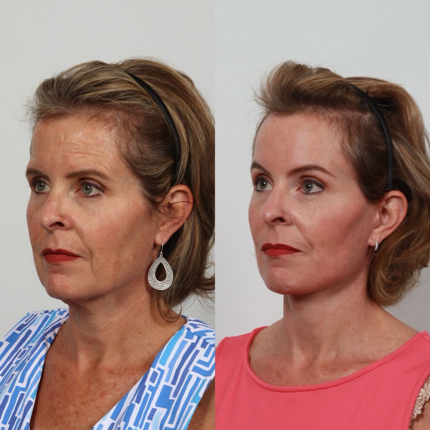 Deep Plane Facelift Before & After