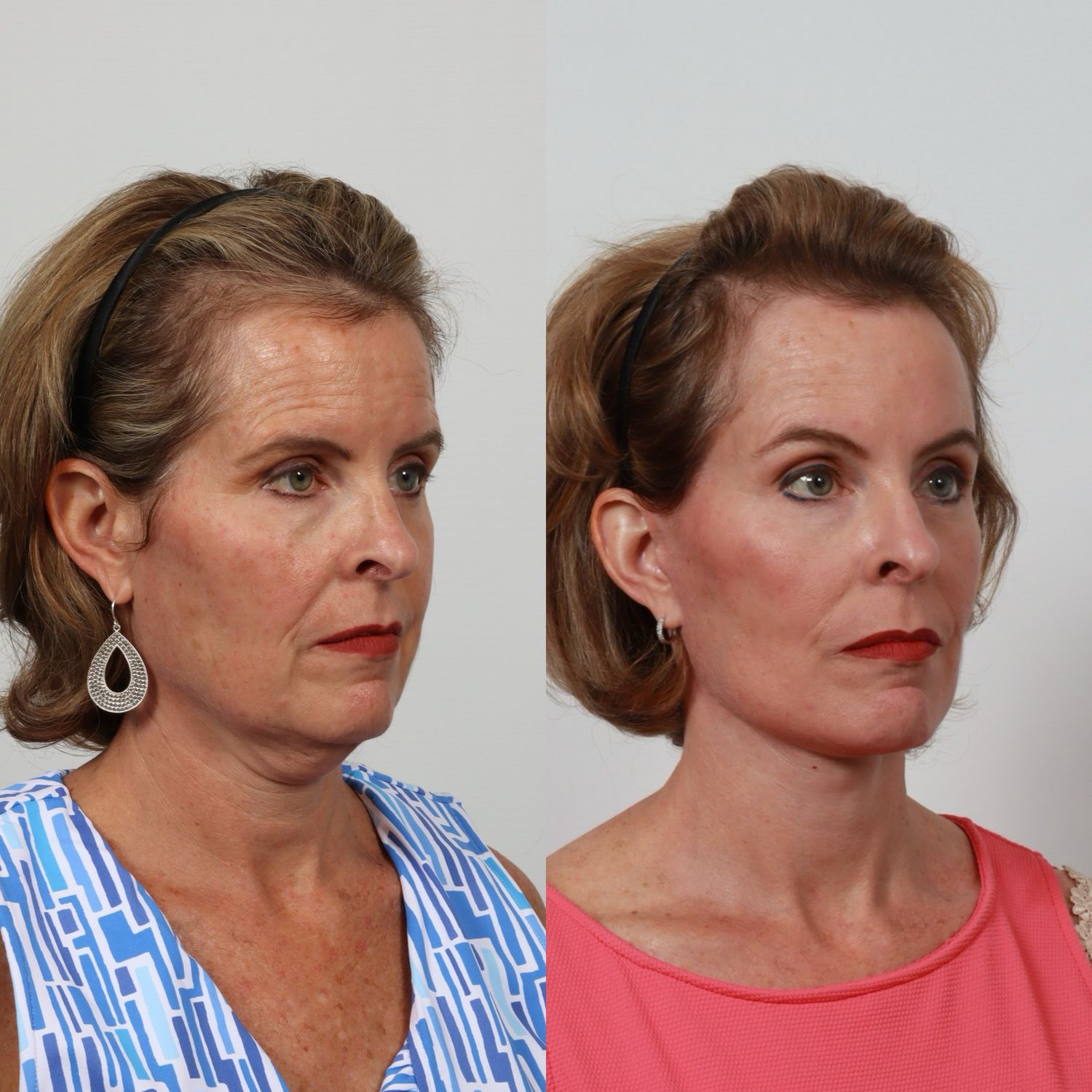 Deep Plane Facelift Before & After
