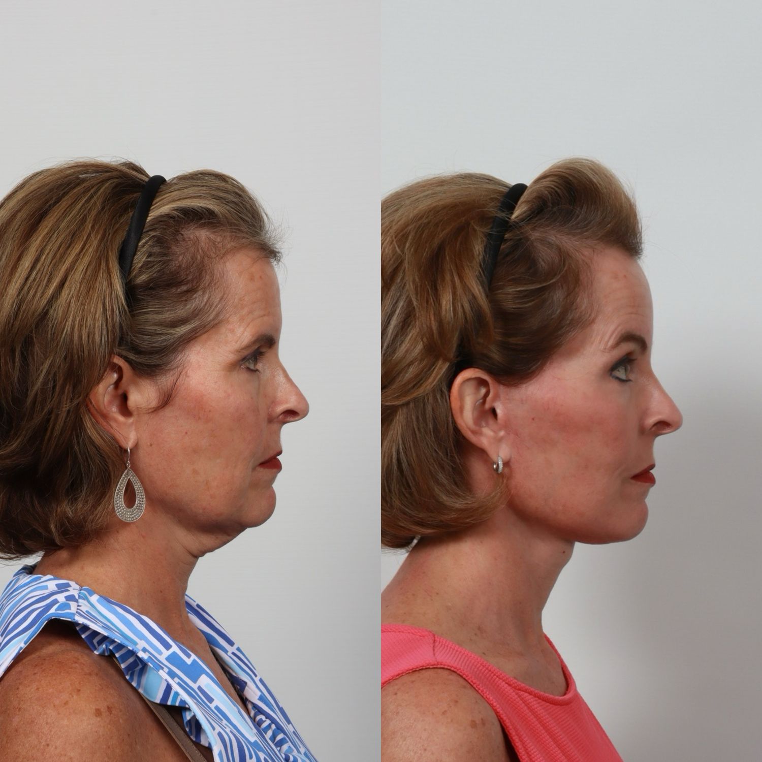 Deep Plane Facelift Before & After