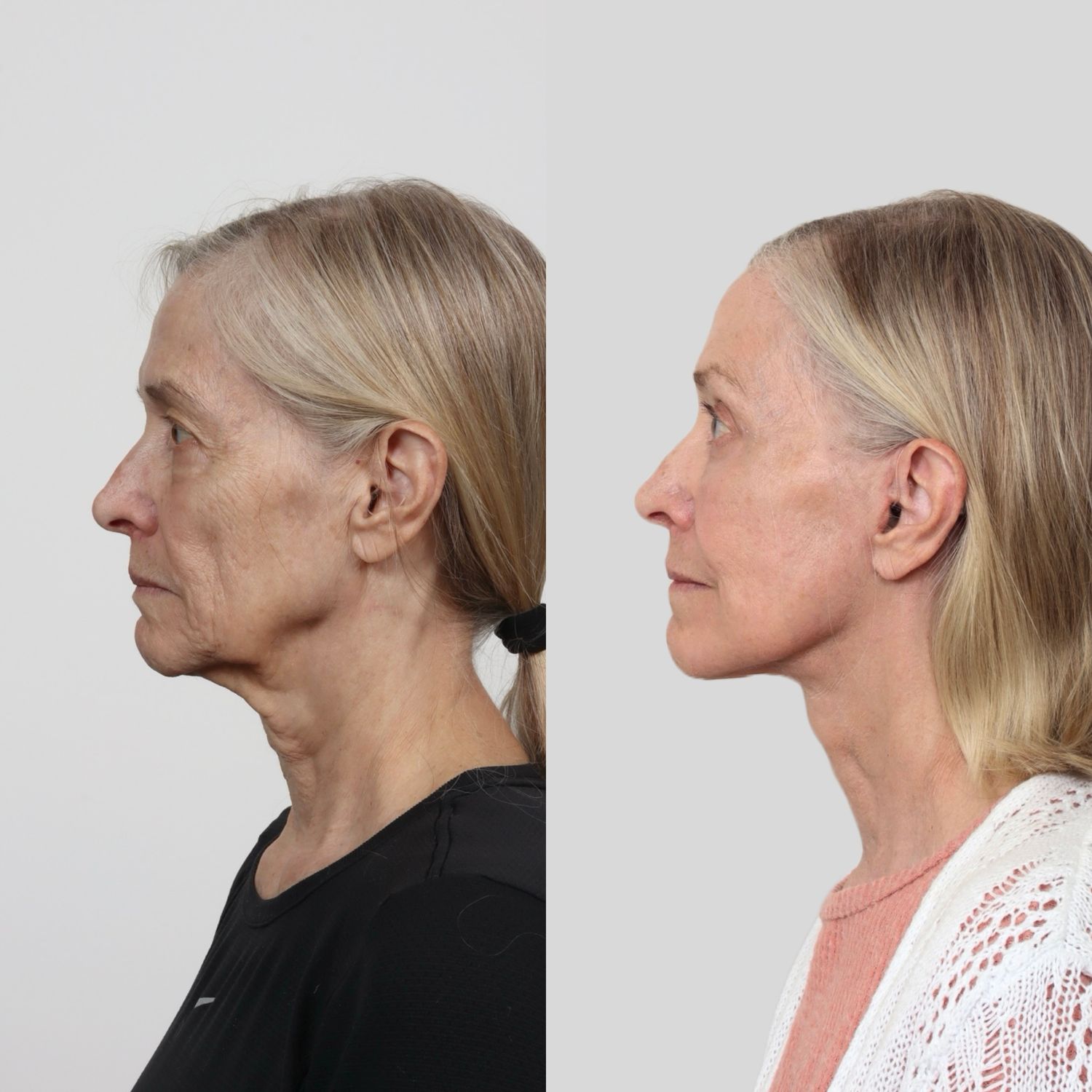 Deep Plane Facelift Before & After
