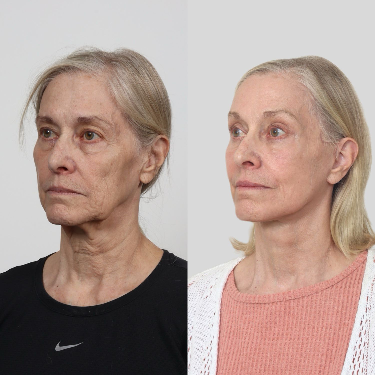 Deep Plane Facelift Before & After
