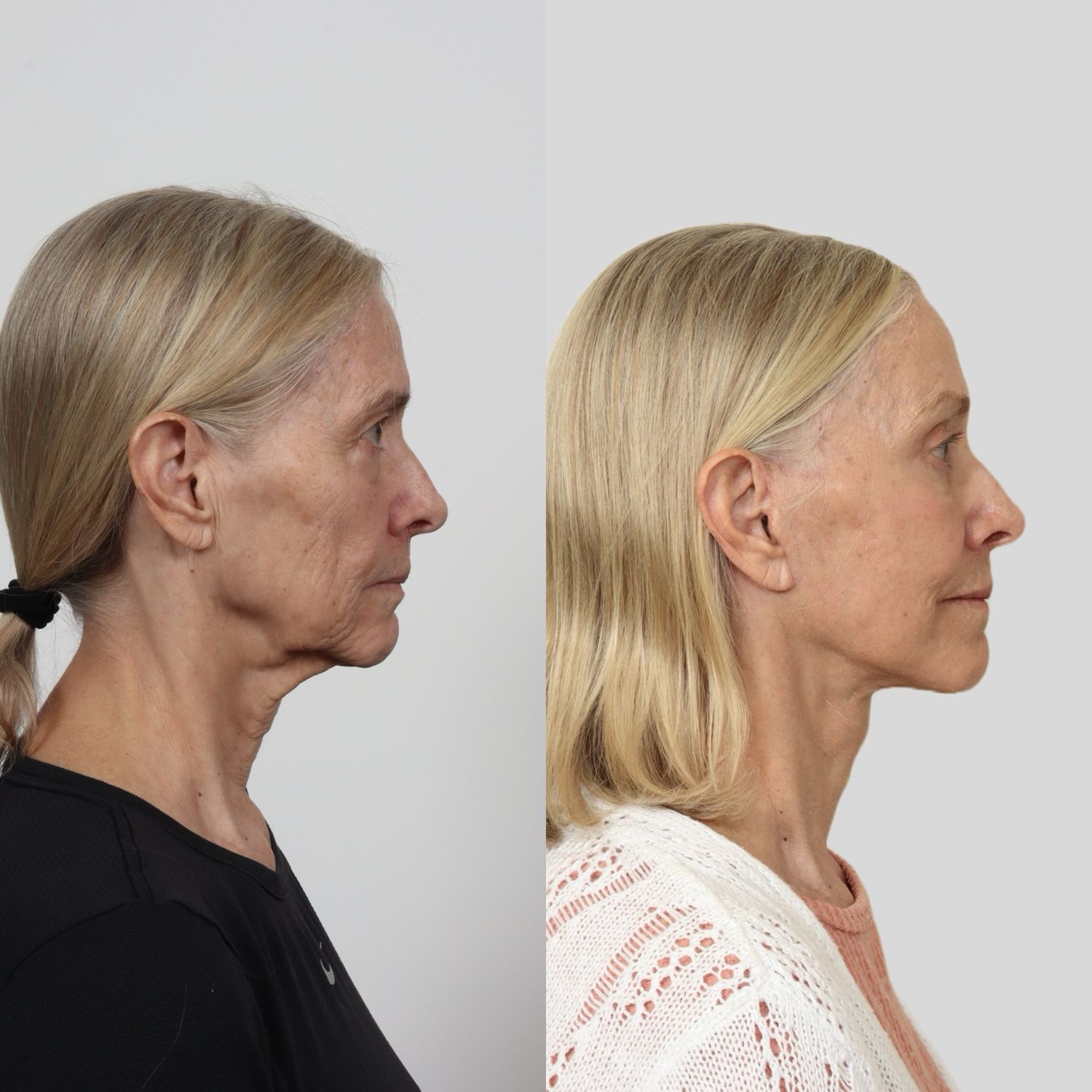 Deep Plane Facelift Before & After
