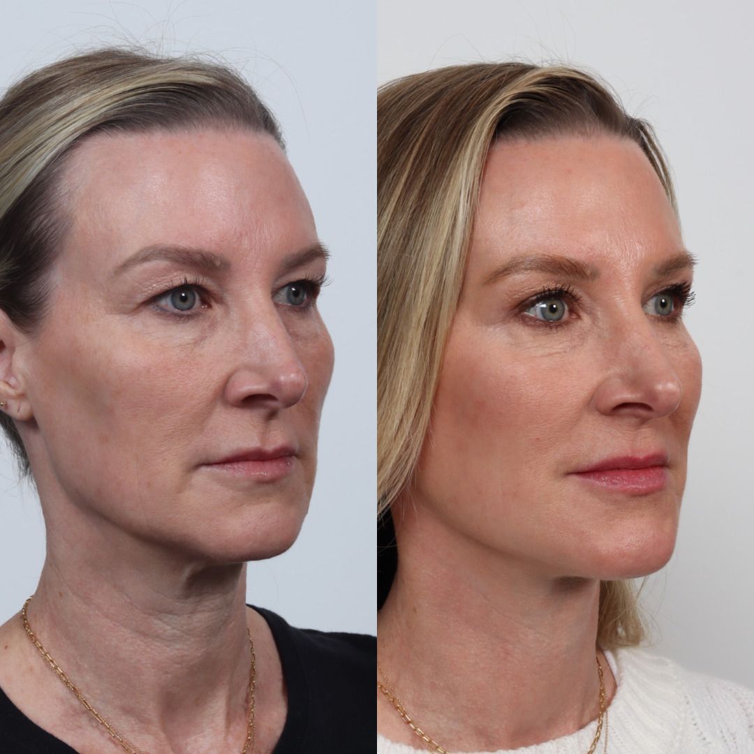 Deep Plane Facelift Before & After