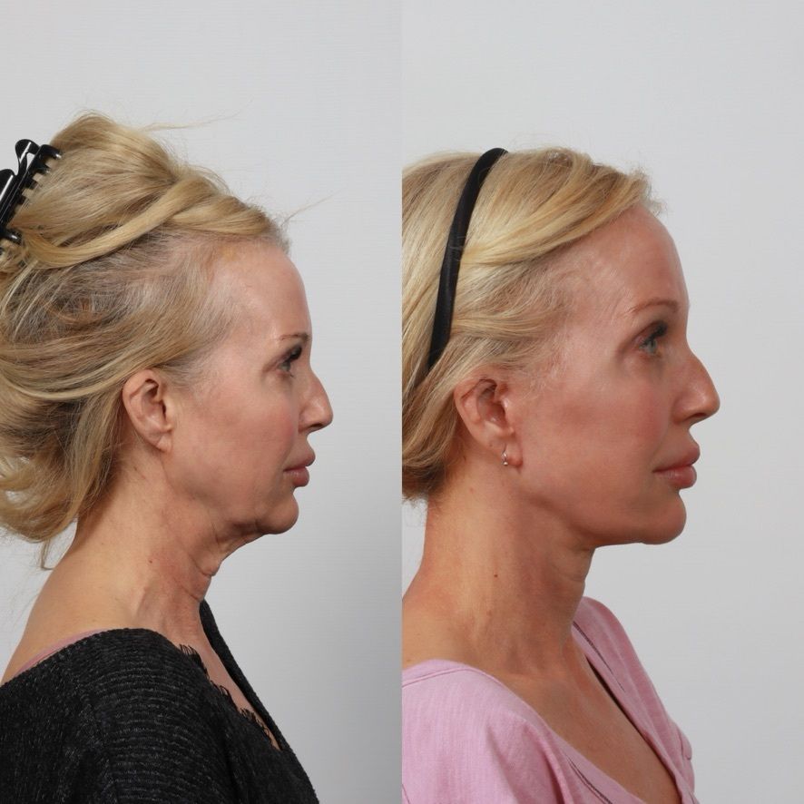 Deep Plane Facelift Before & After