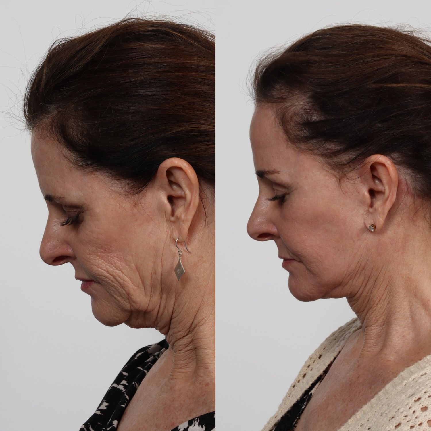 Deep Plane Facelift Before & After