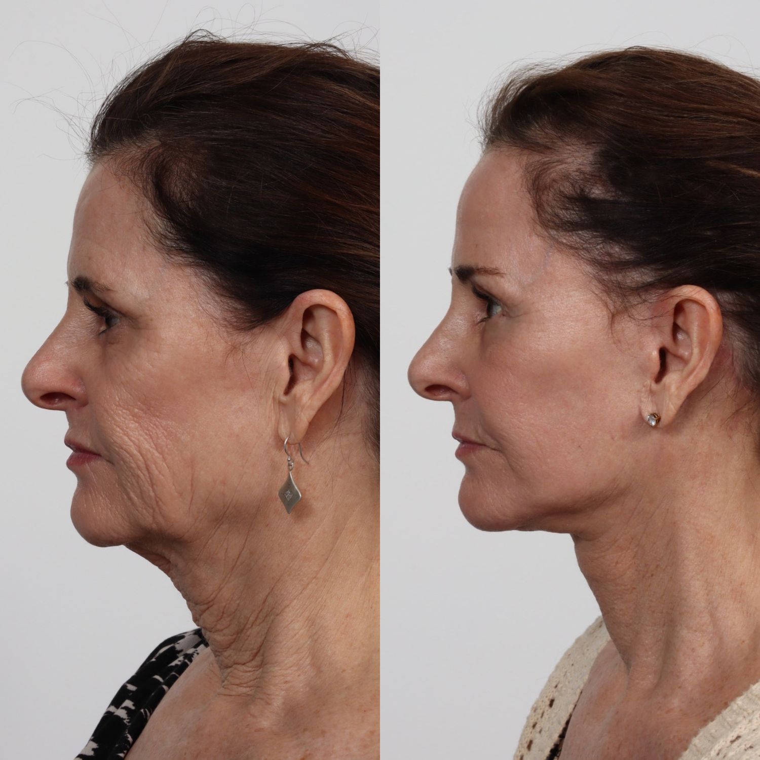 Deep Plane Facelift Before & After