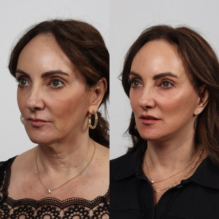 Deep Plane Facelift Before & After