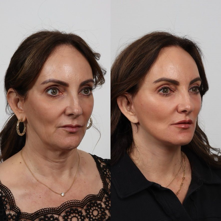 Deep Plane Facelift Before & After