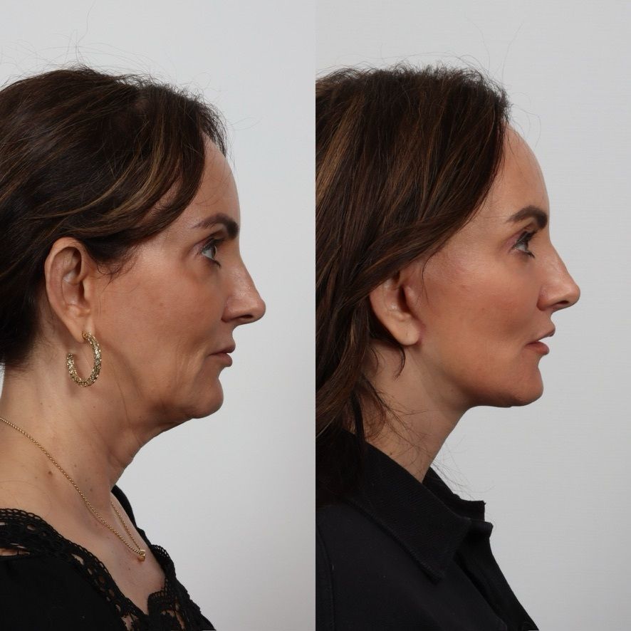 Deep Plane Facelift Before & After