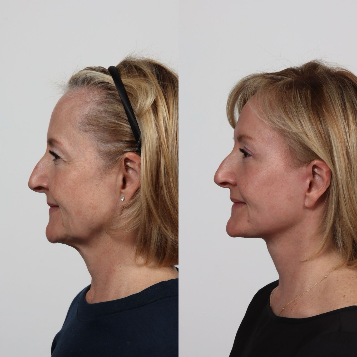 Deep Plane Facelift Before & After