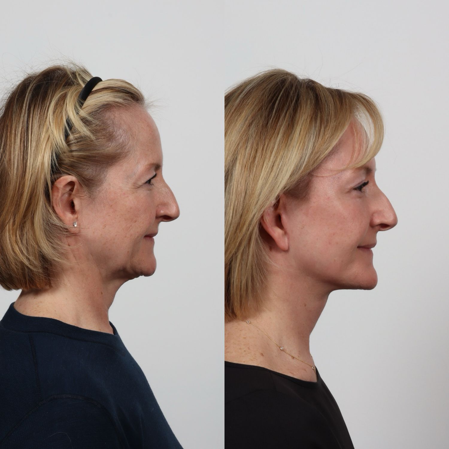 Deep Plane Facelift Before & After