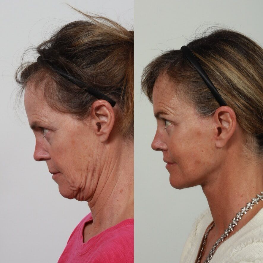 Deep Plane Facelift Before & After