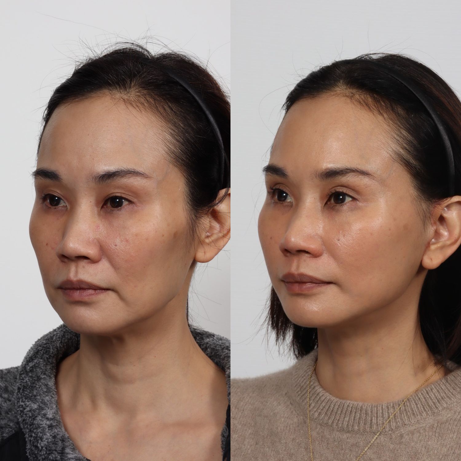 Deep Plane Facelift Before & After