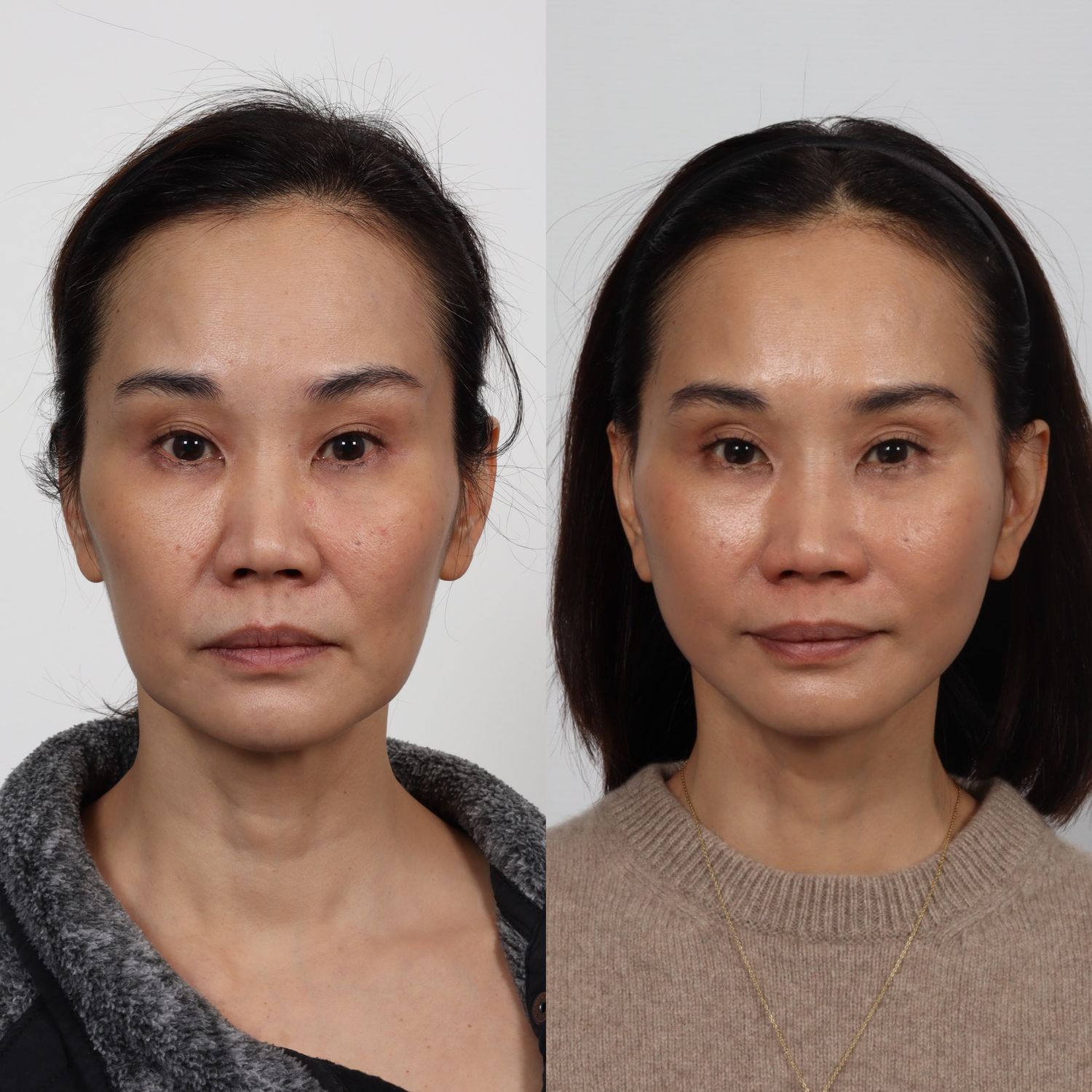 Deep Plane Facelift Before & After
