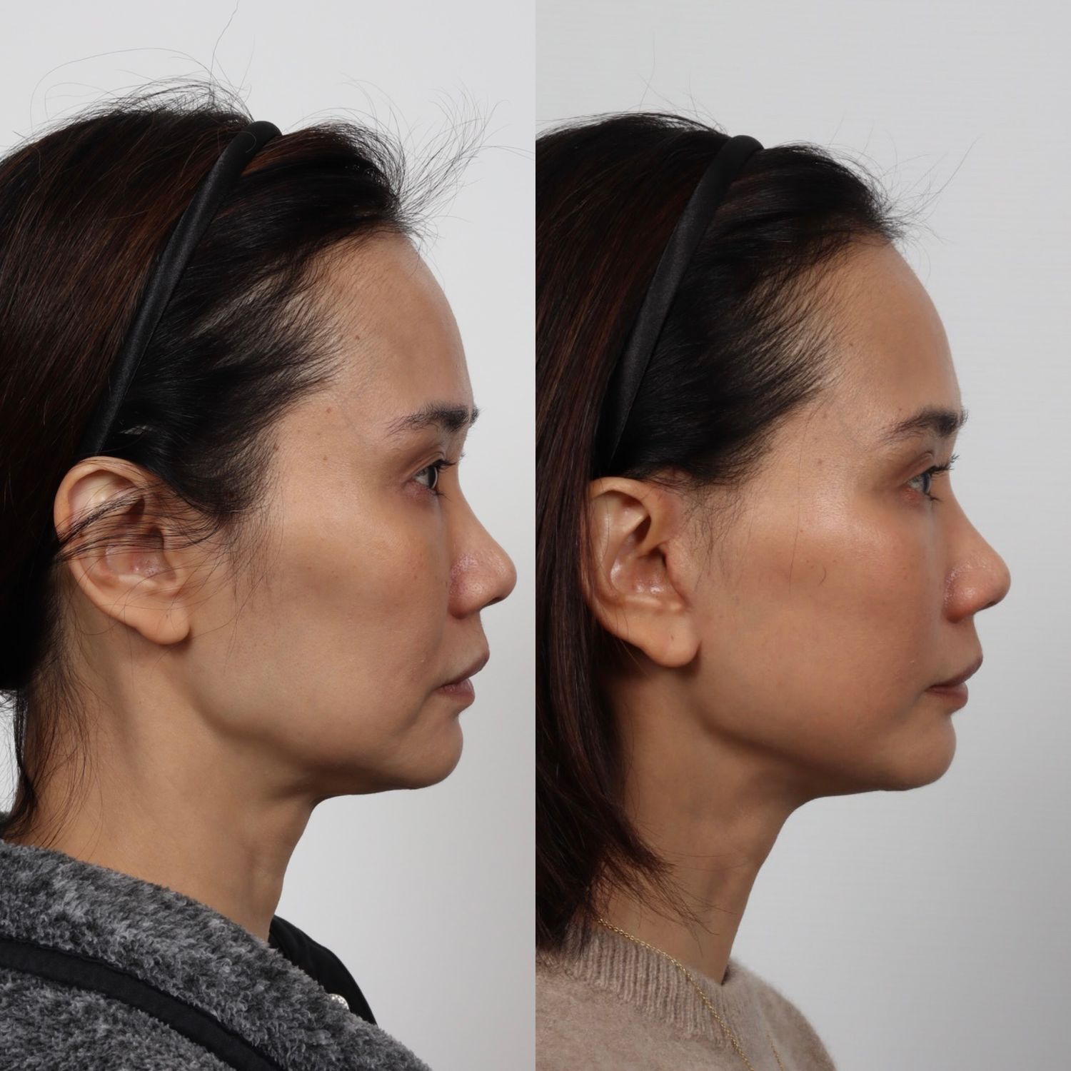 Deep Plane Facelift Before & After