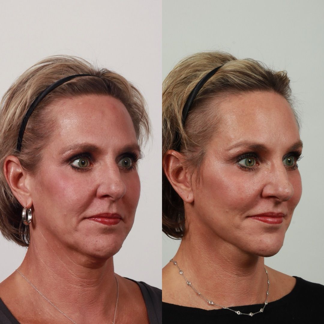 Deep Plane Facelift Before & After