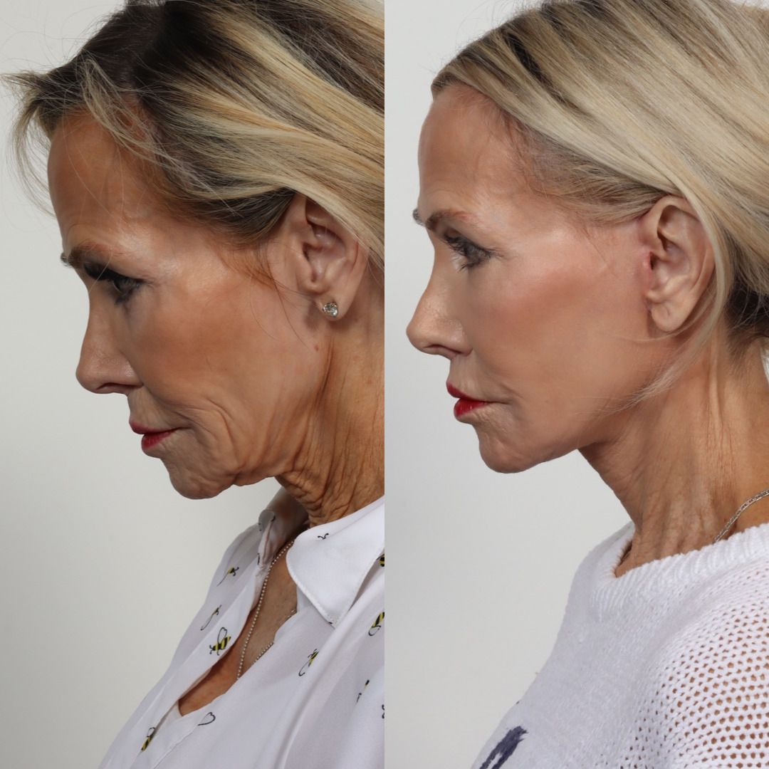 Deep Plane Facelift Before & After