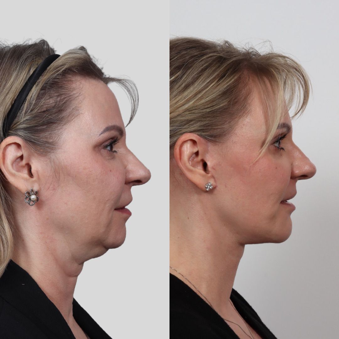 Deep Plane Facelift Before & After