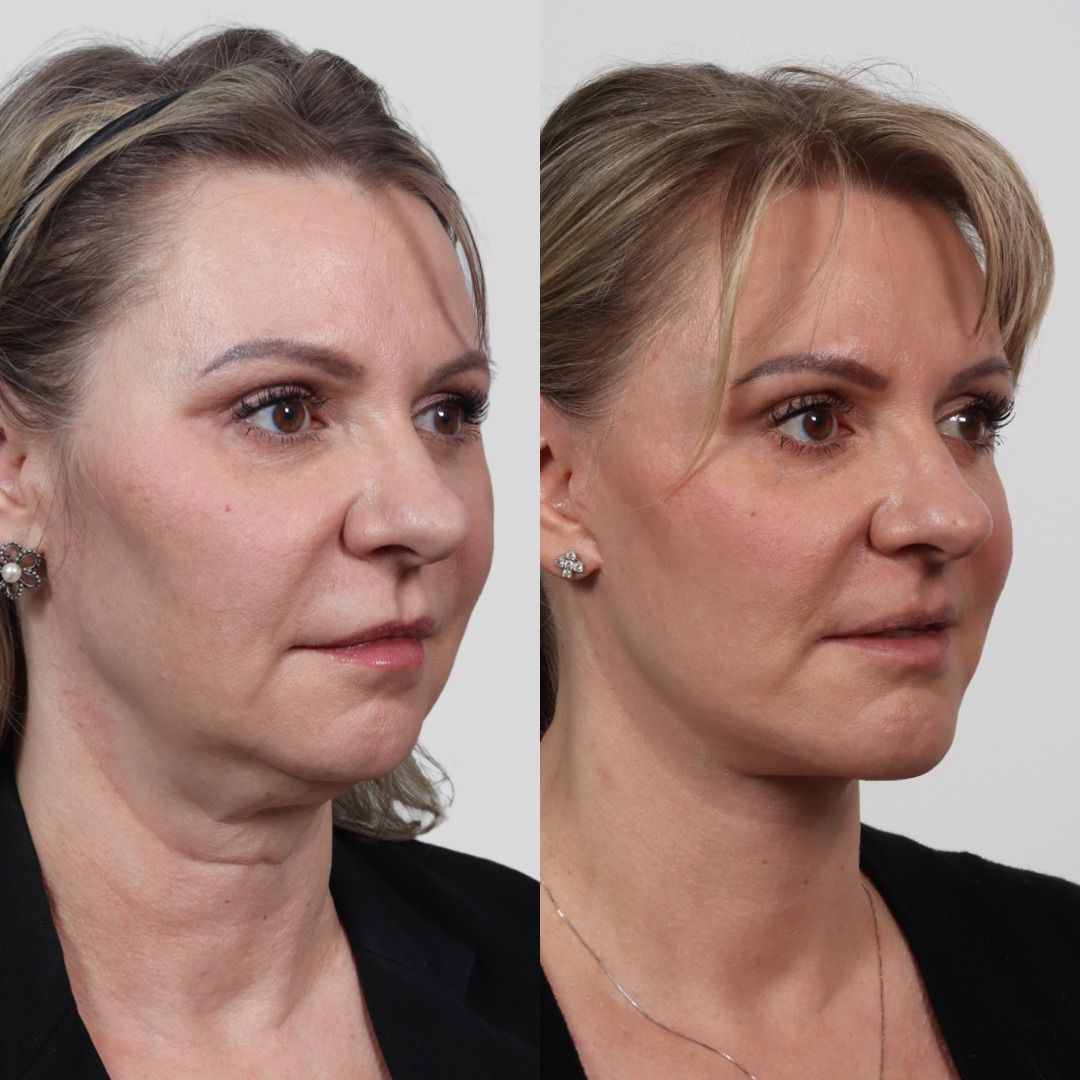 Deep Plane Facelift Before & After