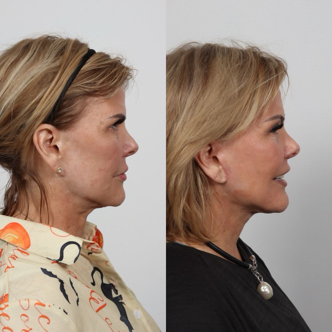 Deep Plane Facelift Before & After