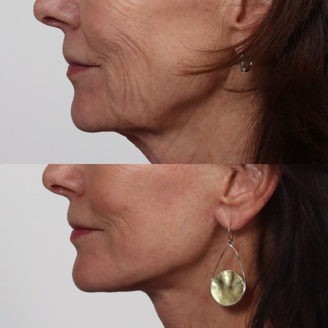 Deep Plane Facelift Before & After