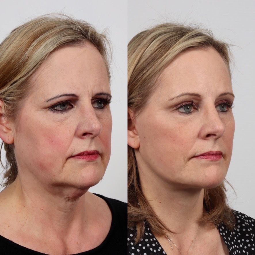 Deep Plane Facelift Before & After