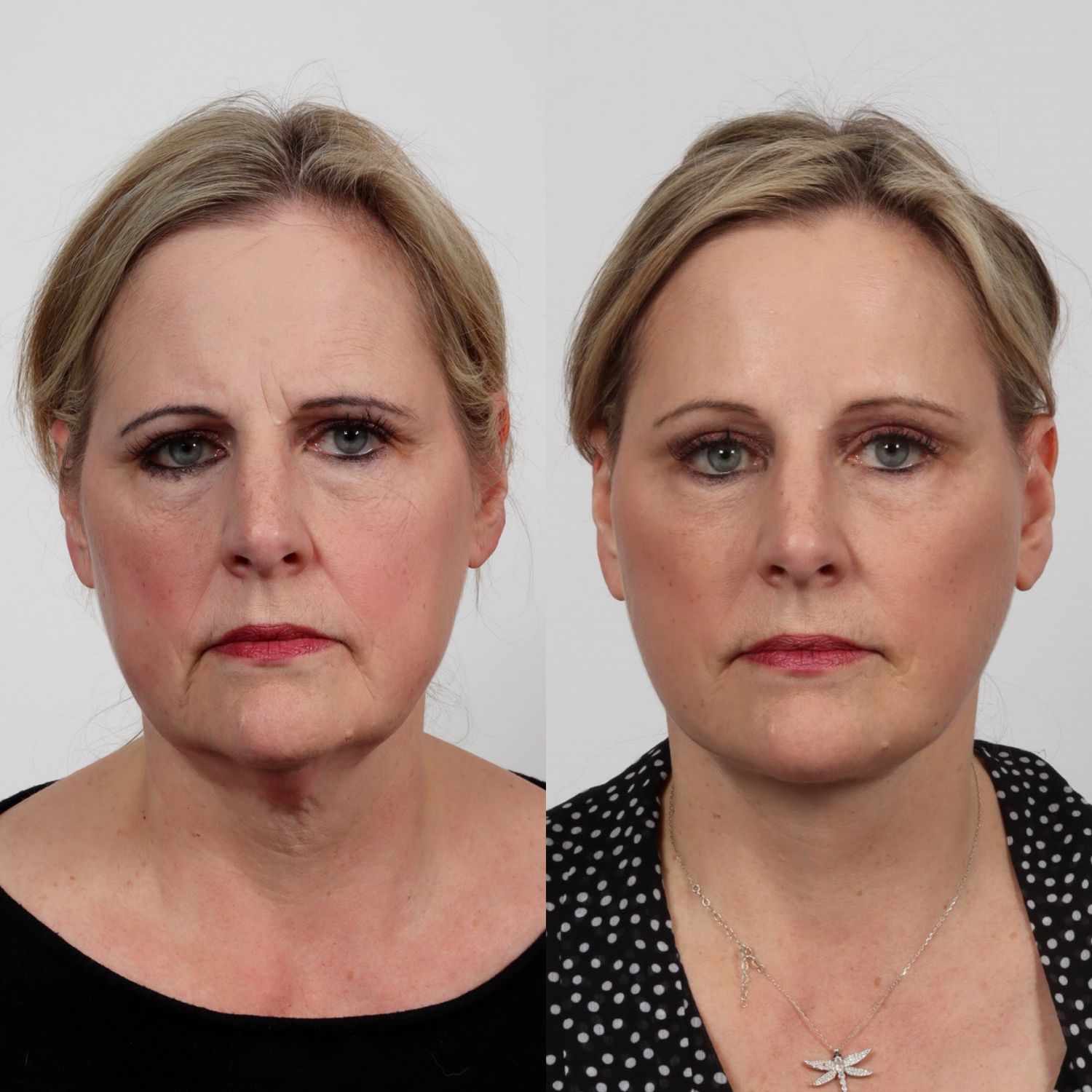 Deep Plane Facelift Before & After