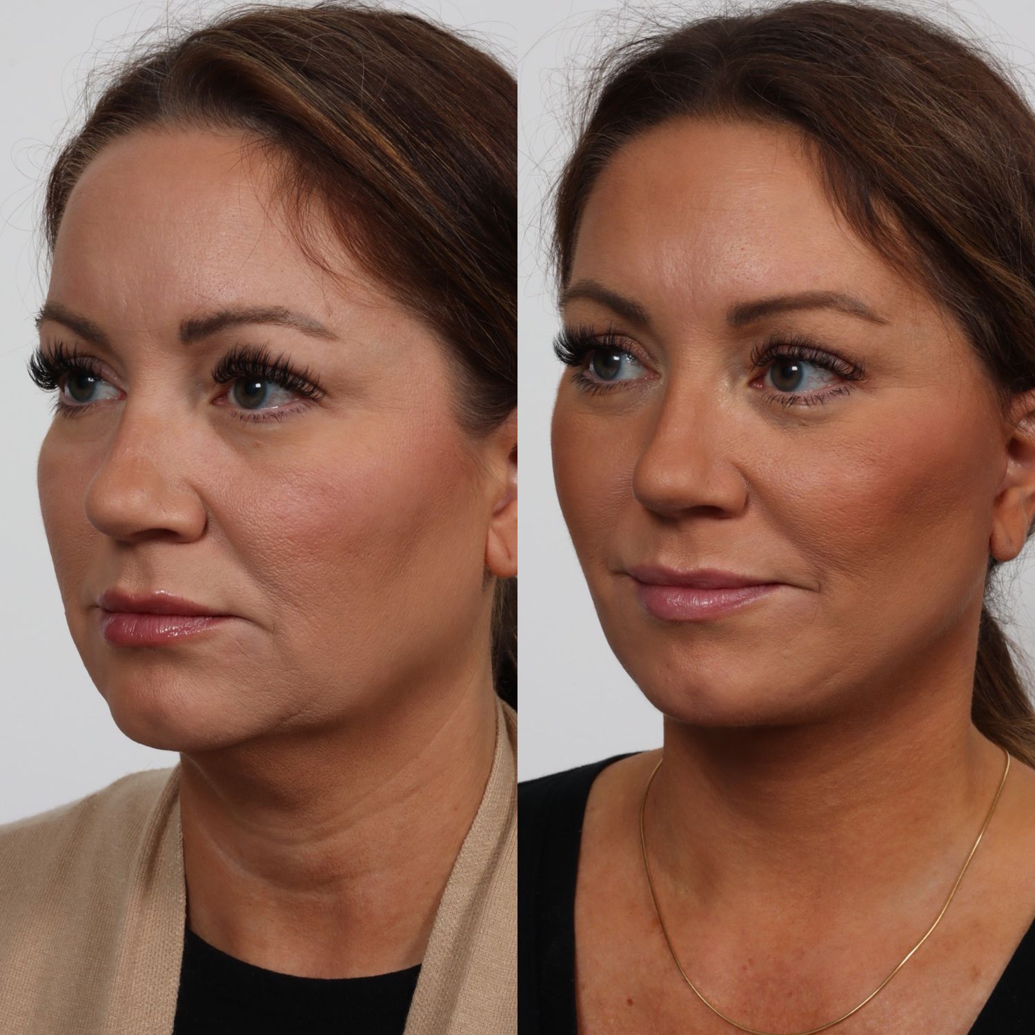 Deep Plane Facelift Before & After