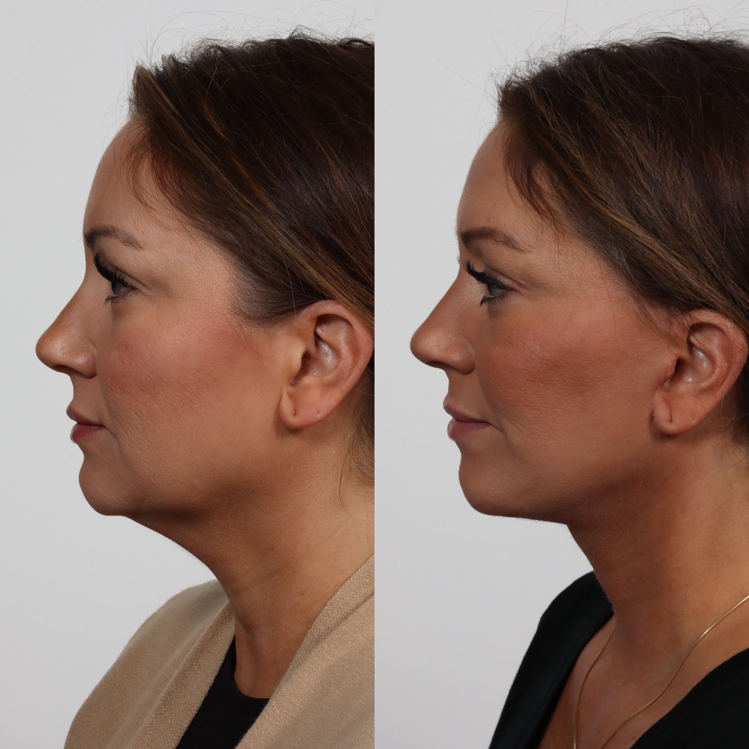Deep Plane Facelift Before & After