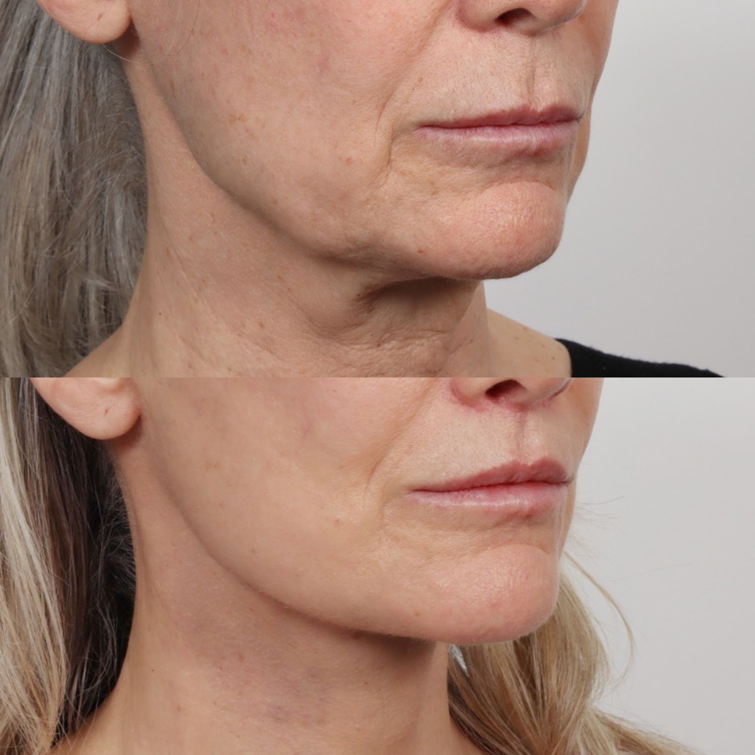 Deep Plane Facelift Before & After