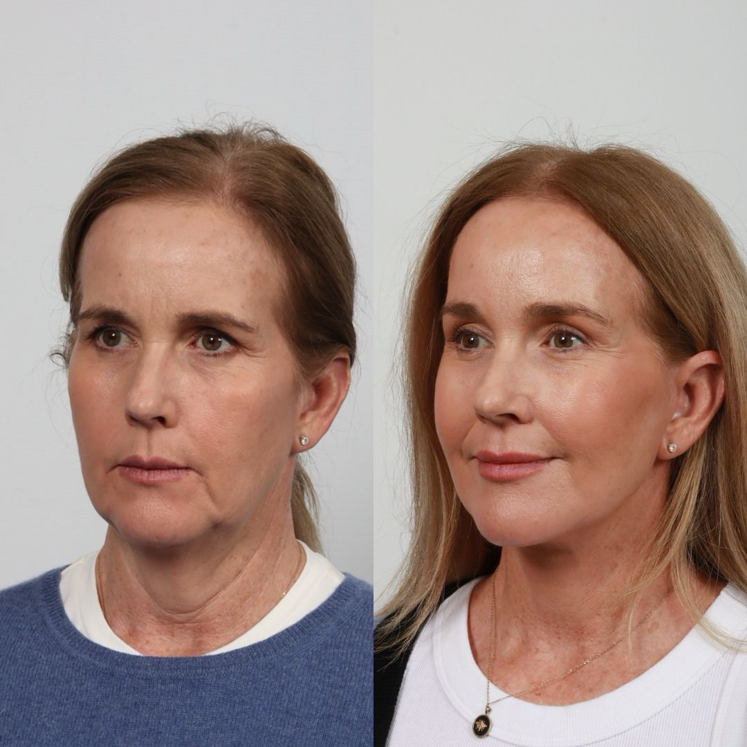 Deep Plane Facelift Before & After