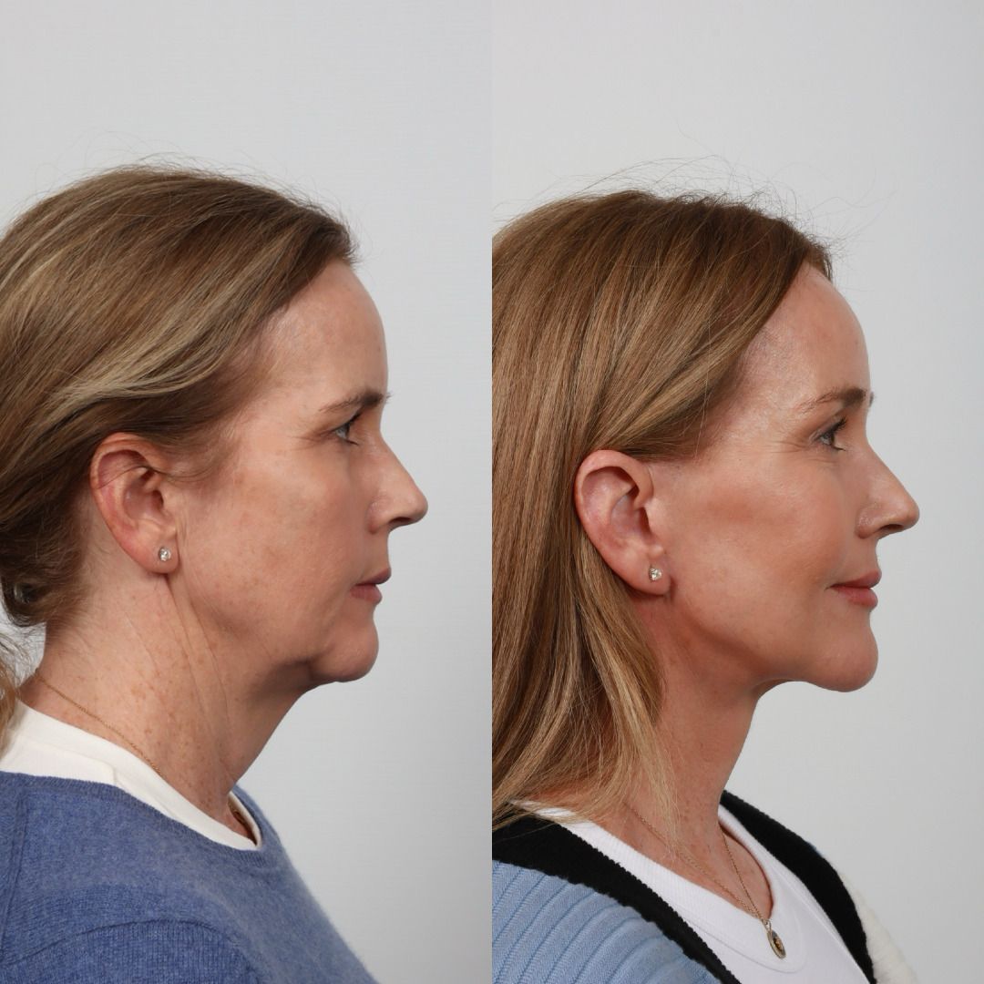 Deep Plane Facelift Before & After