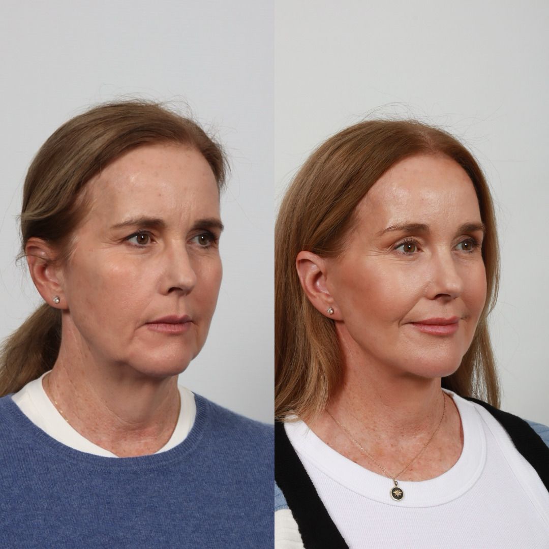 Deep Plane Facelift Before & After