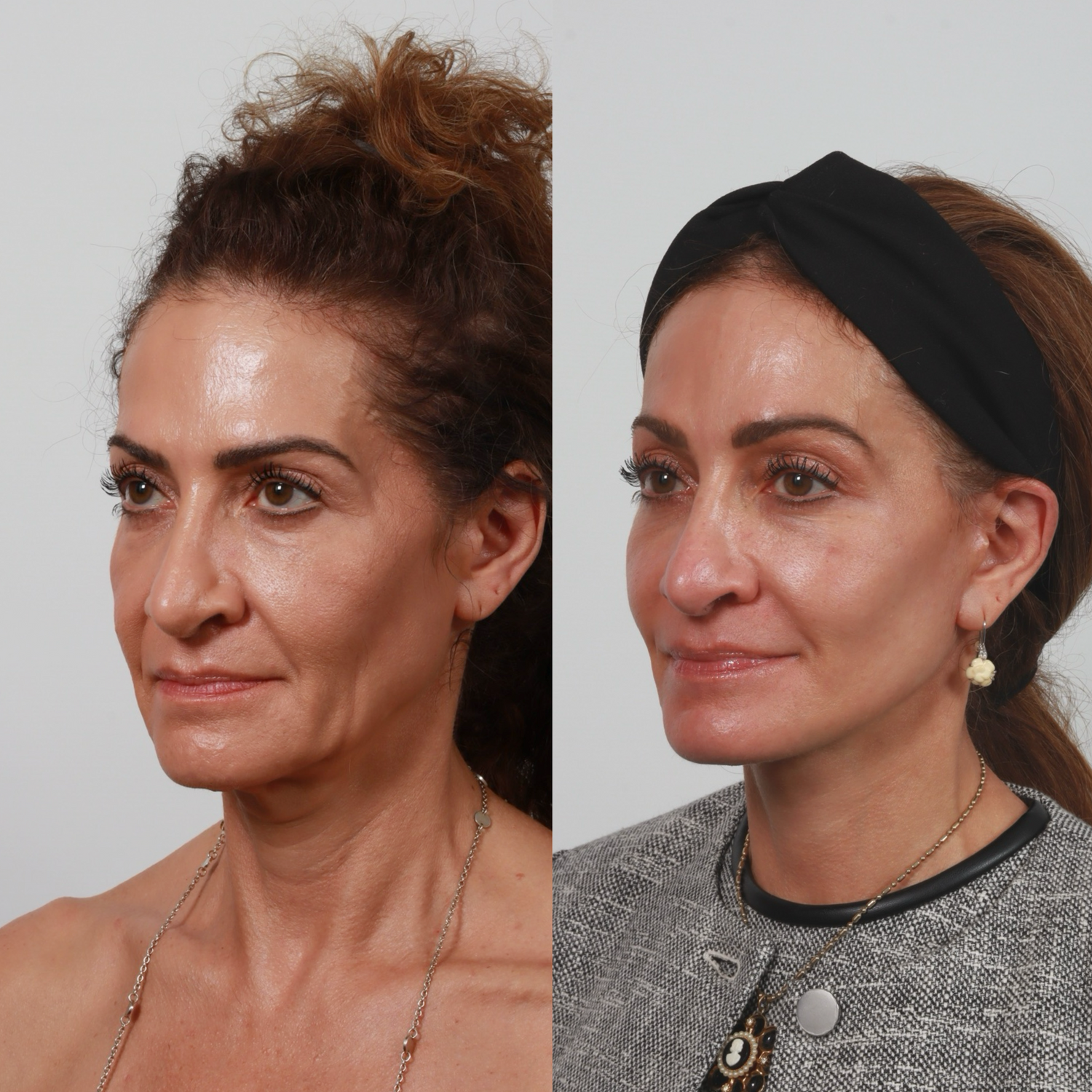 Deep Plane Facelift Before & After