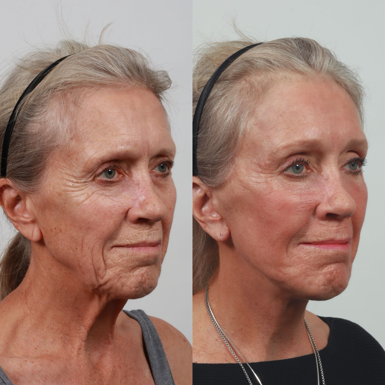 Deep Plane Facelift Before & After