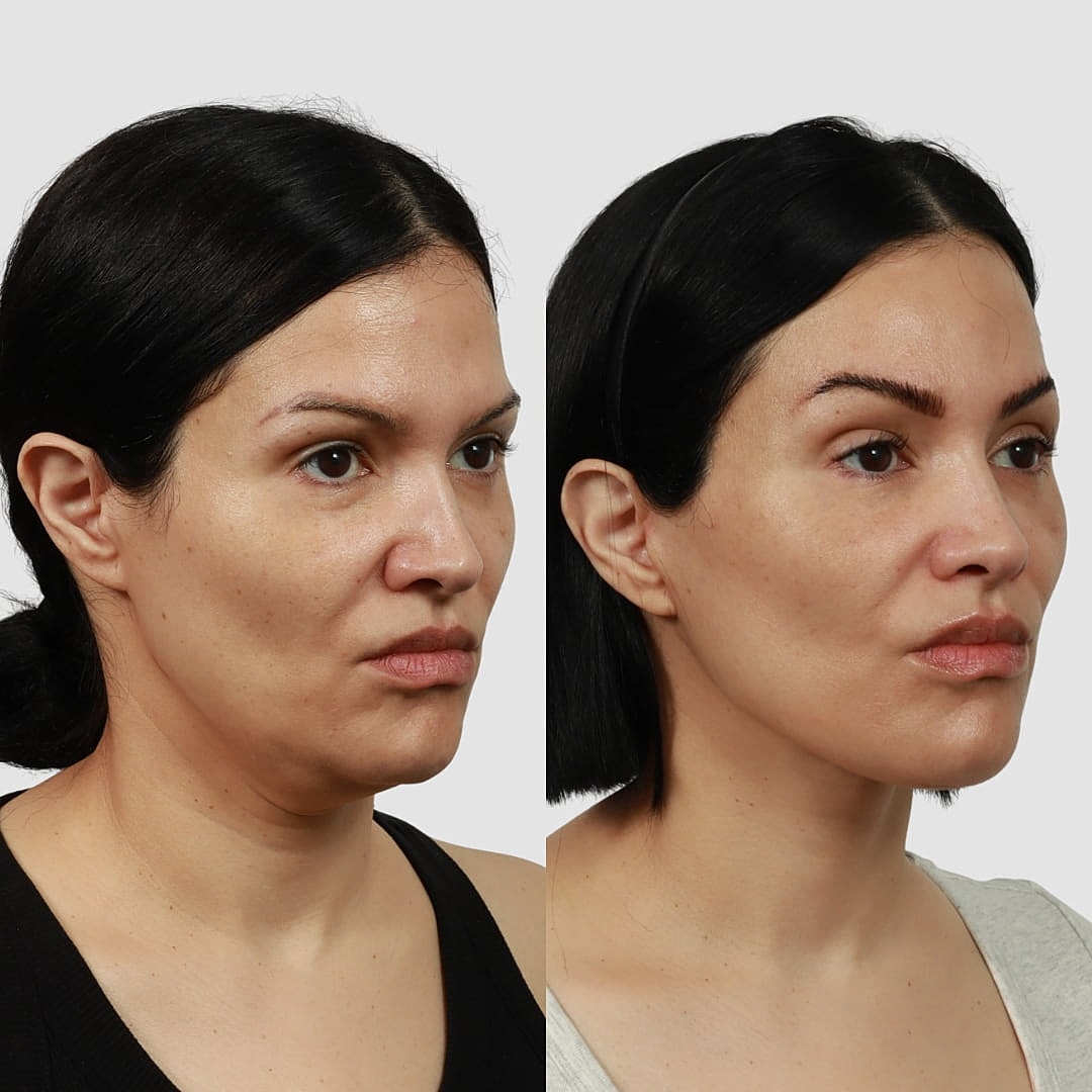 Deep Plane Facelift Before & After