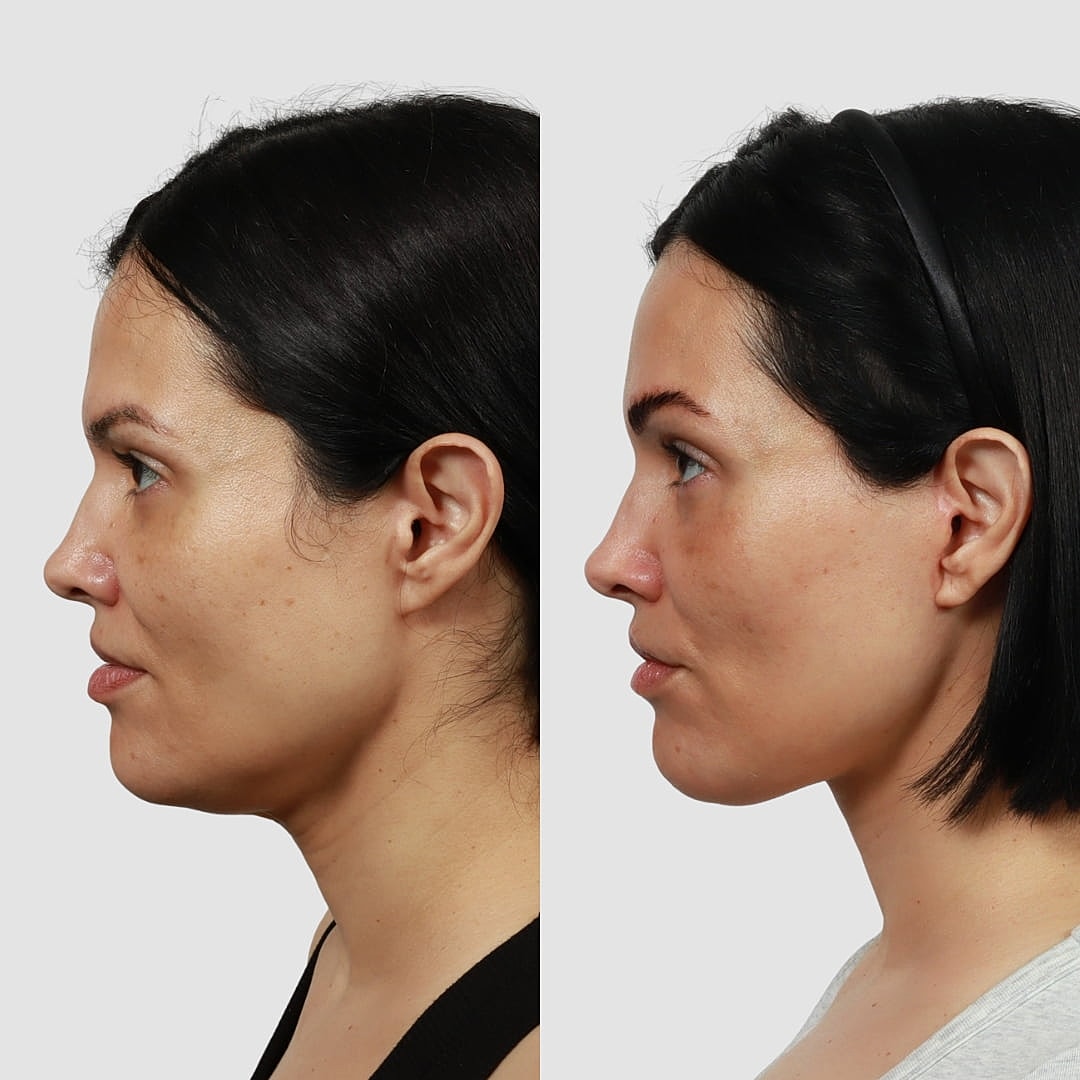 Deep Plane Facelift Before & After