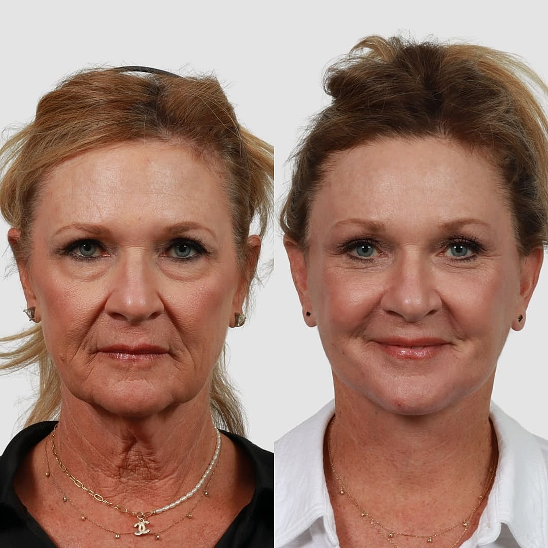 Deep Plane Facelift Before & After