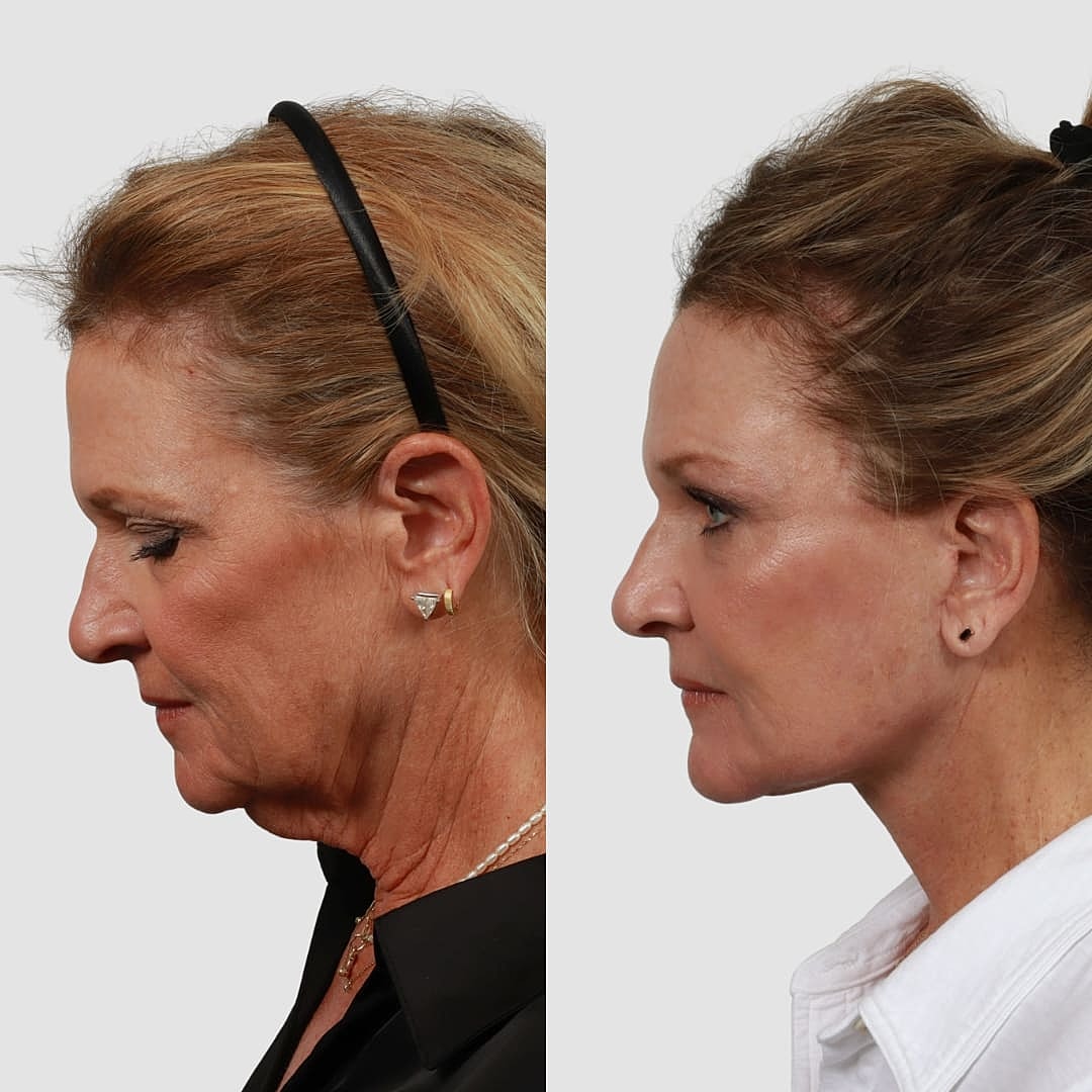 Deep Plane Facelift Before & After