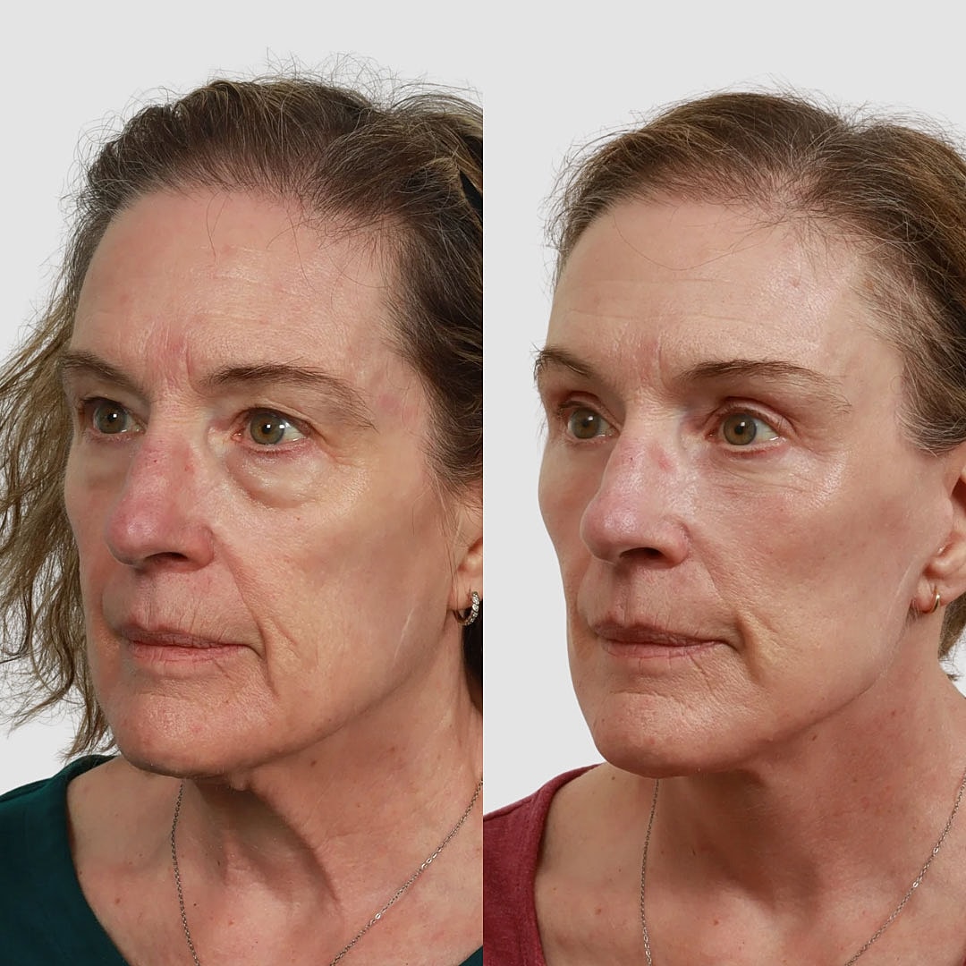 Deep Plane Facelift Before & After