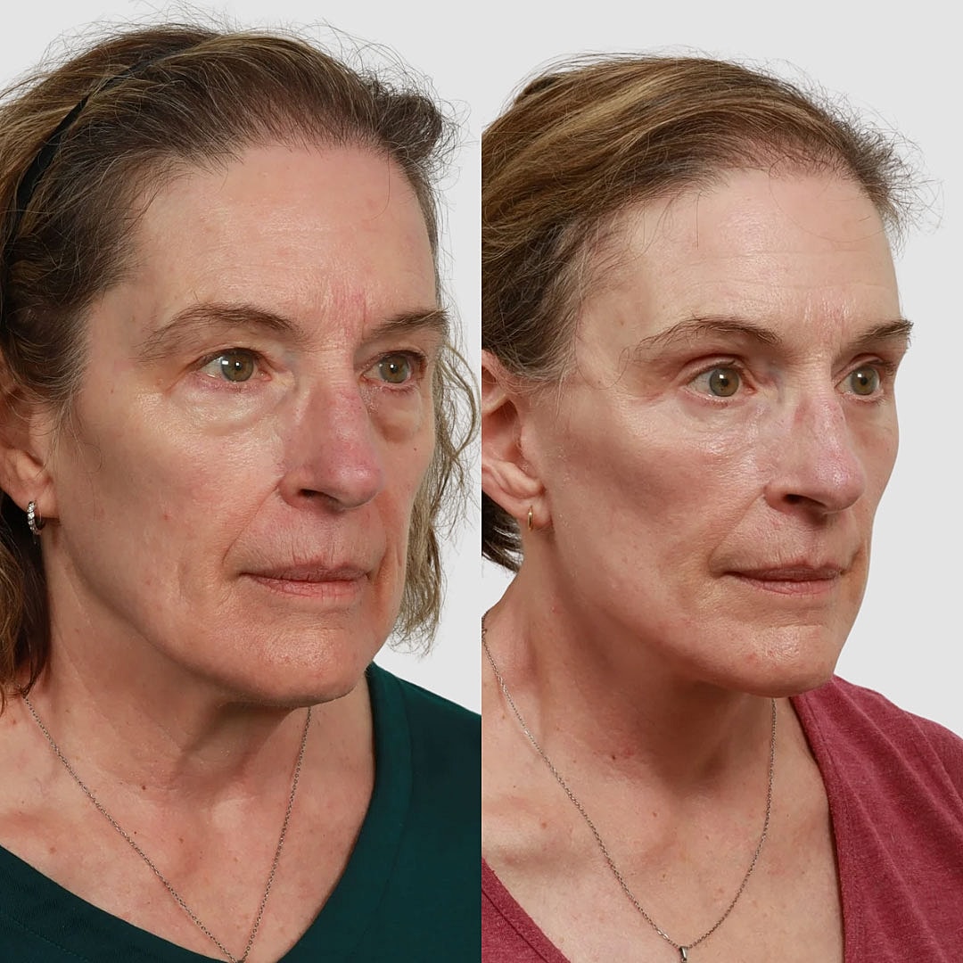 Deep Plane Facelift Before & After