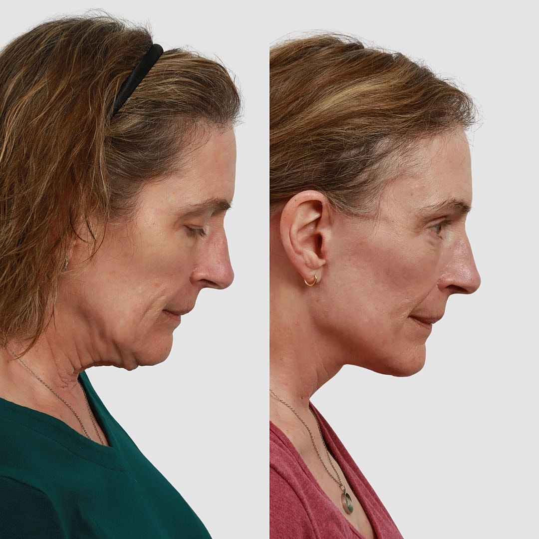 Deep Plane Facelift Before & After