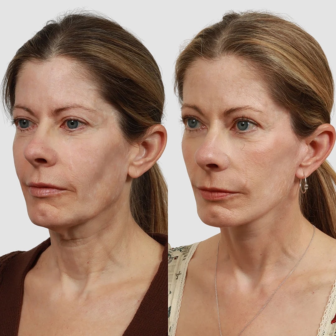 Deep Plane Facelift Before & After